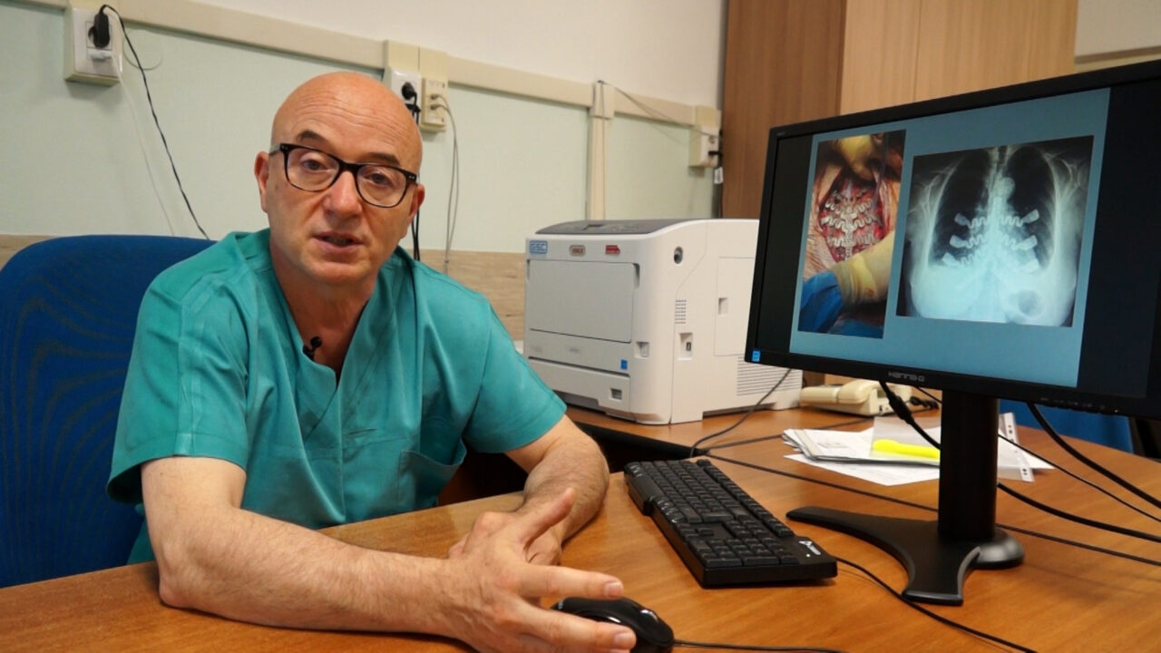 Tumore osseo allo sterno, creata a Cuneo innovativa protesi su misura da immagini Tac